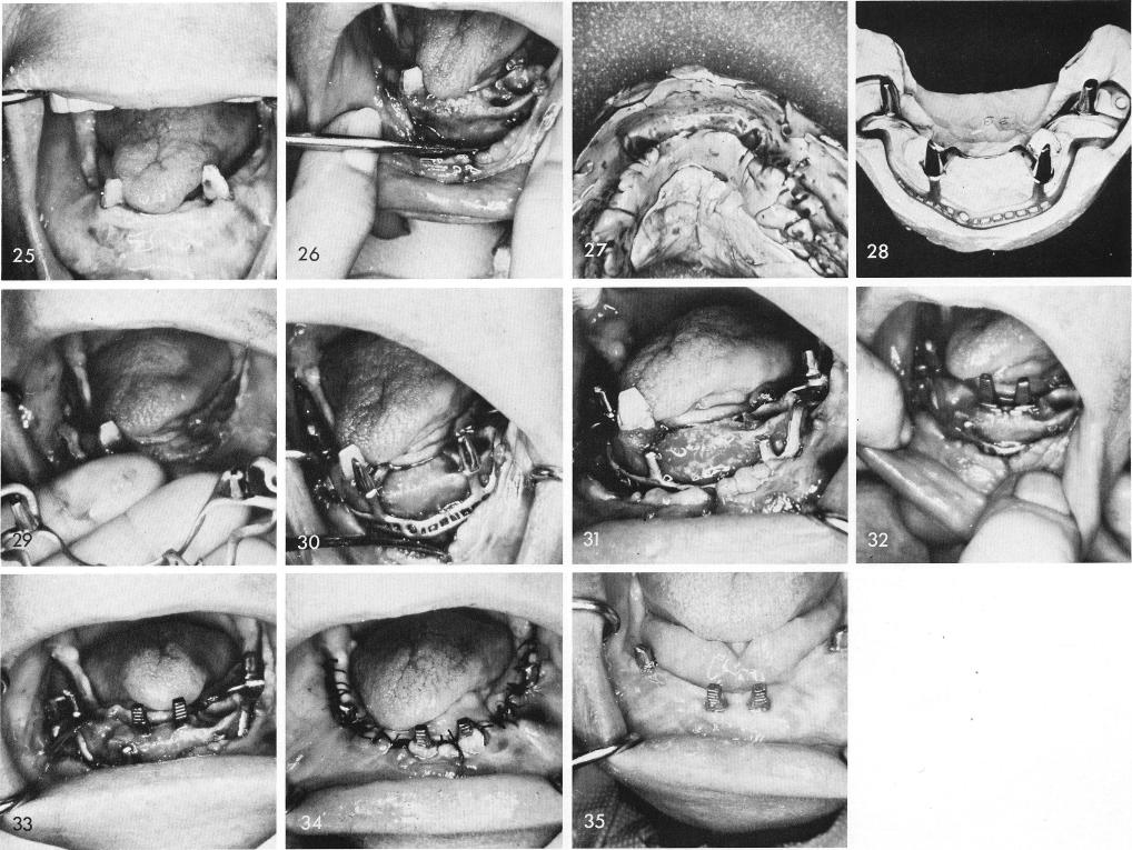 1 Case showing a patient with severe overbite and overjet