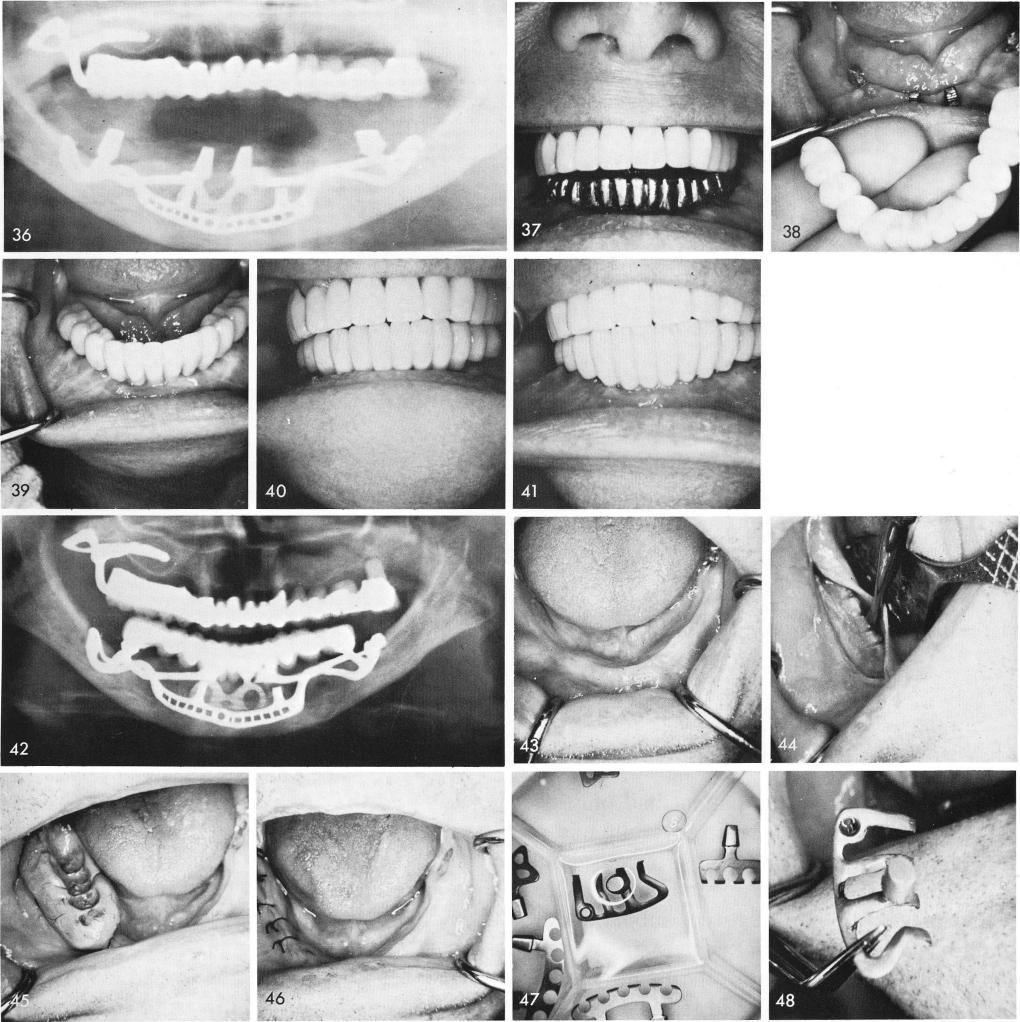 1 X ray of mandibular subperiosteal implant and anterior blade implant
