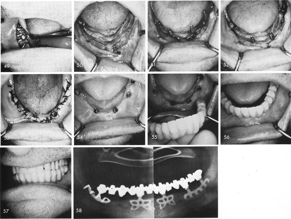1 Exact fit of subperiosteal implant with bladevent implants in mandible