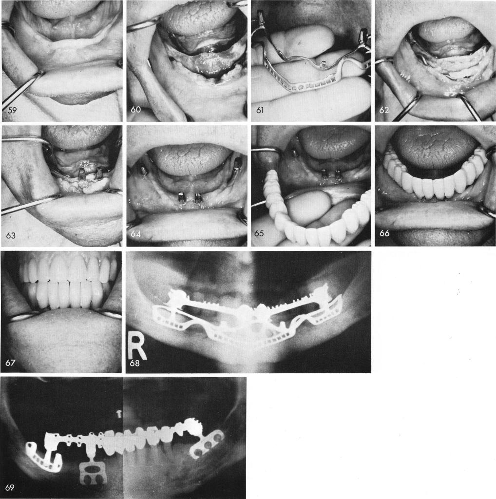 1 Totally edentulous mandible prepared for a full subperiosteal implant