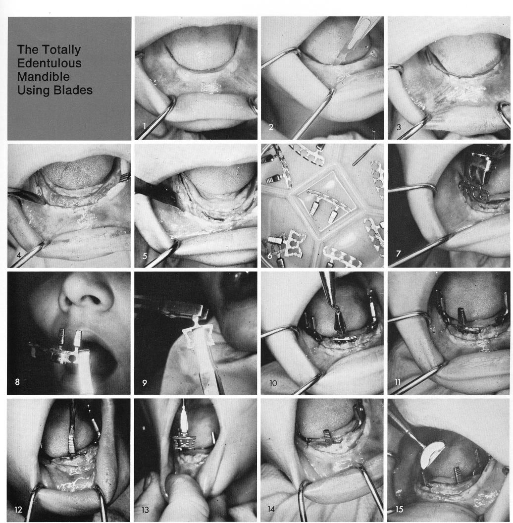 1 Totally edentulous mandible before implant placement