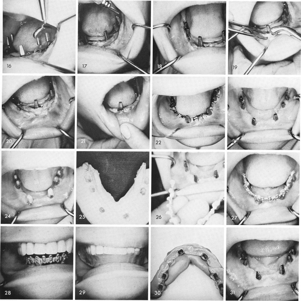 1 Tissue punch usage when more tissue exists near blade post in mandible