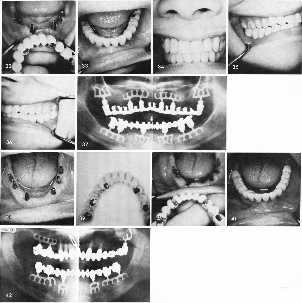 1 Narrower cuspid blade posts in mandible for better aesthetics