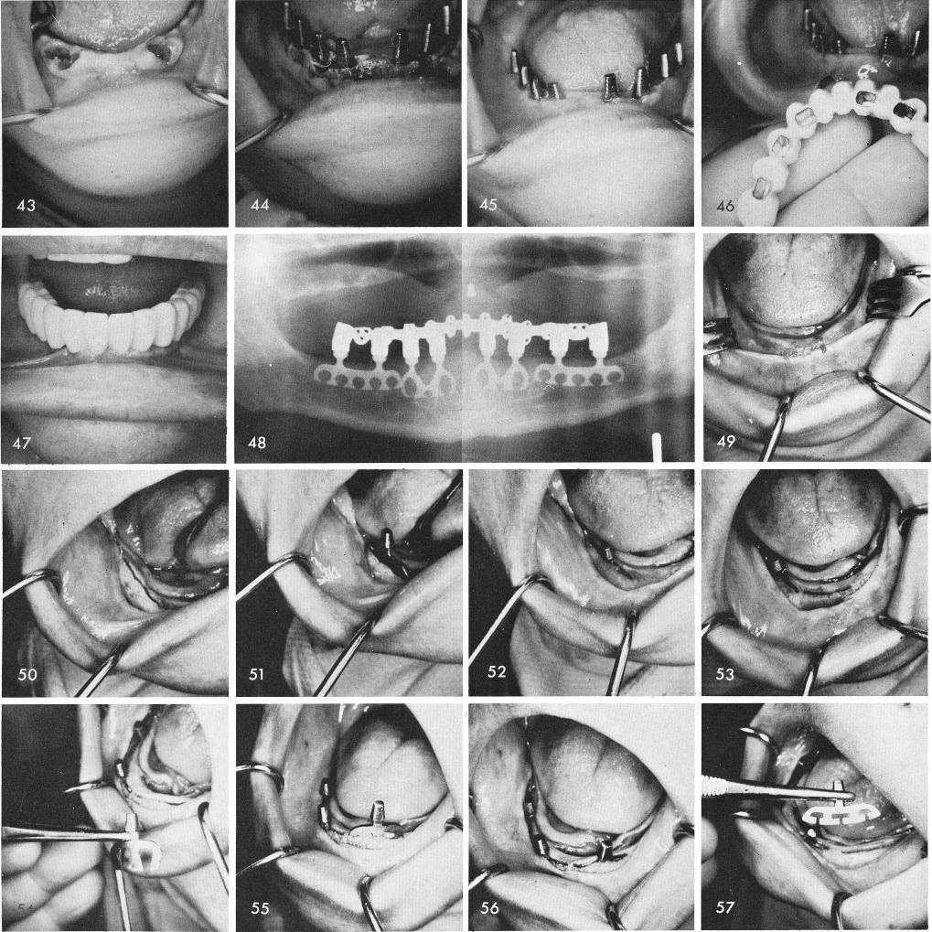 1 Totally edentulous mandible with fresh sockets