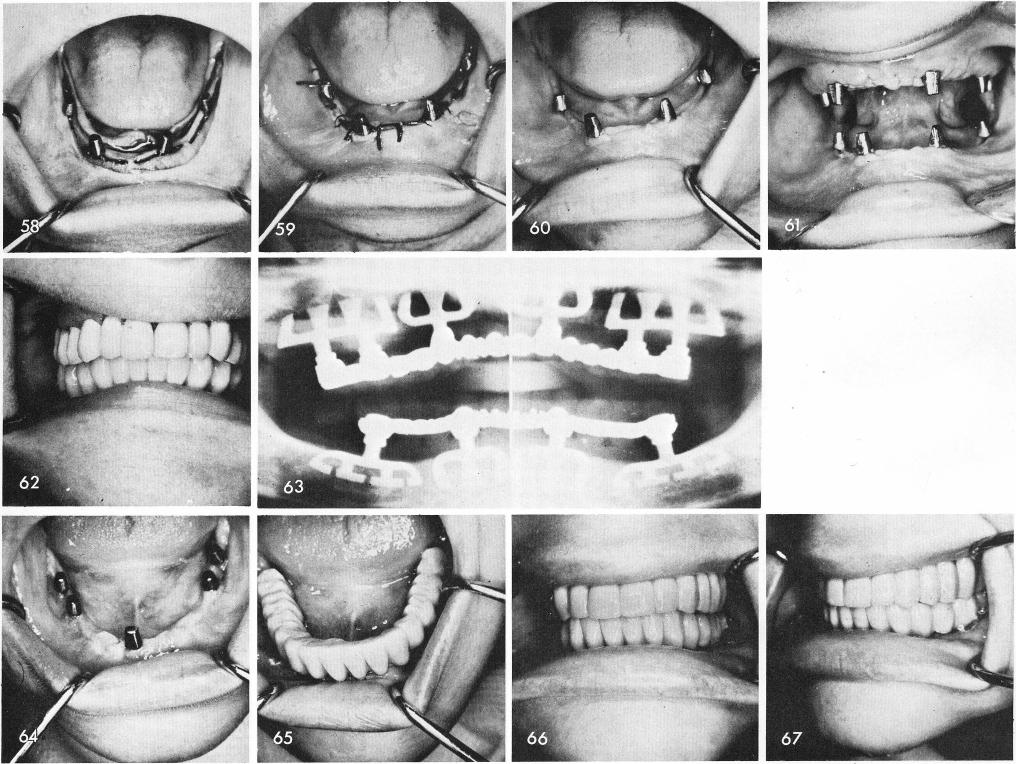 1 Post operative x ray of final prosthesis over mandibular implants