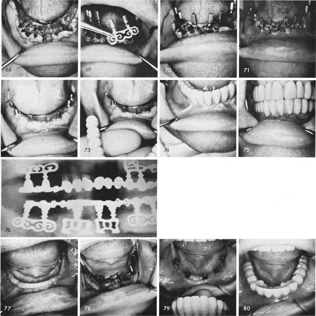 1 Edentulous mandible with several fresh sockets