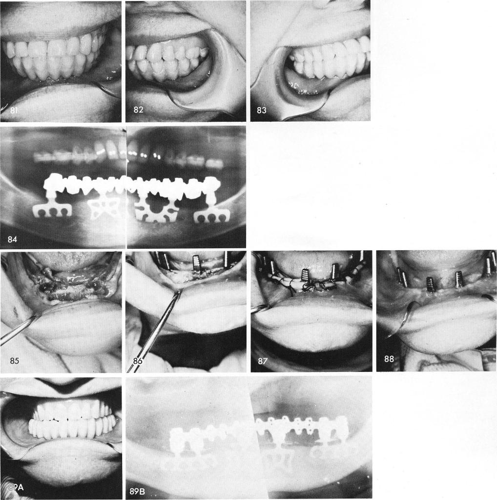 1 Bladevent posts with thick band of attached gingivae around them