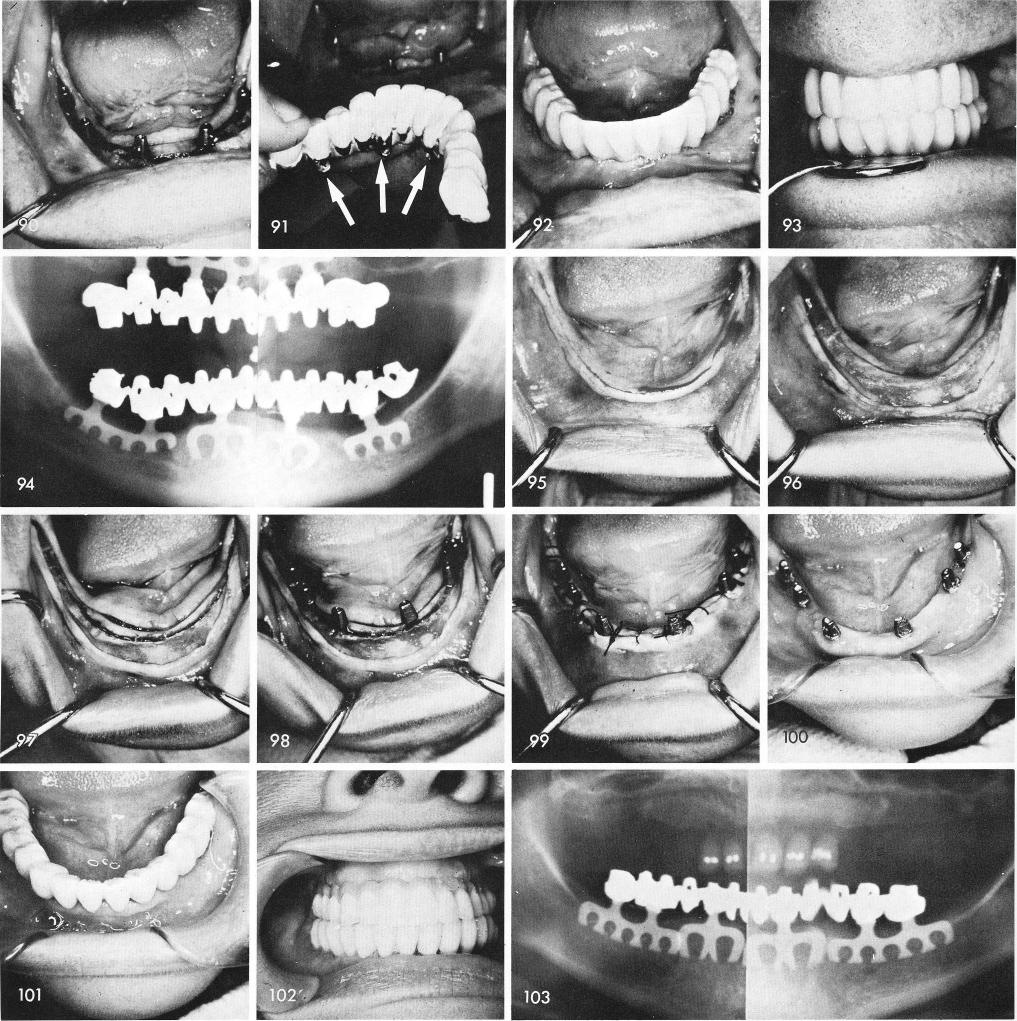 1 Mandibular blade implants with horizontal threading through the posts