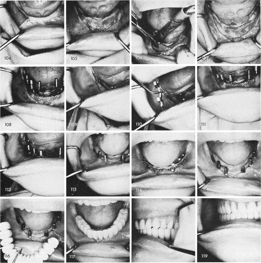 1 Mandibular knife edge ridge