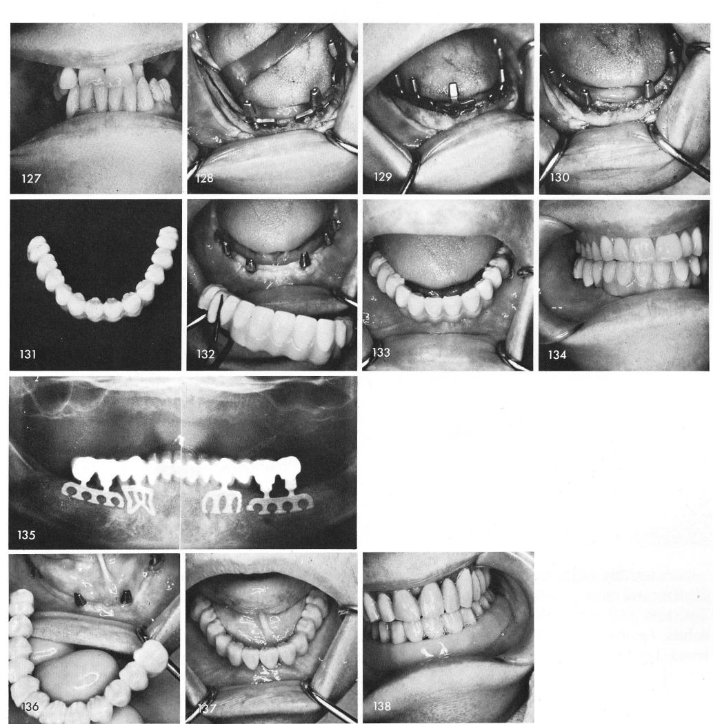 1 Using four protruding posts to support full arch splint in mandible
