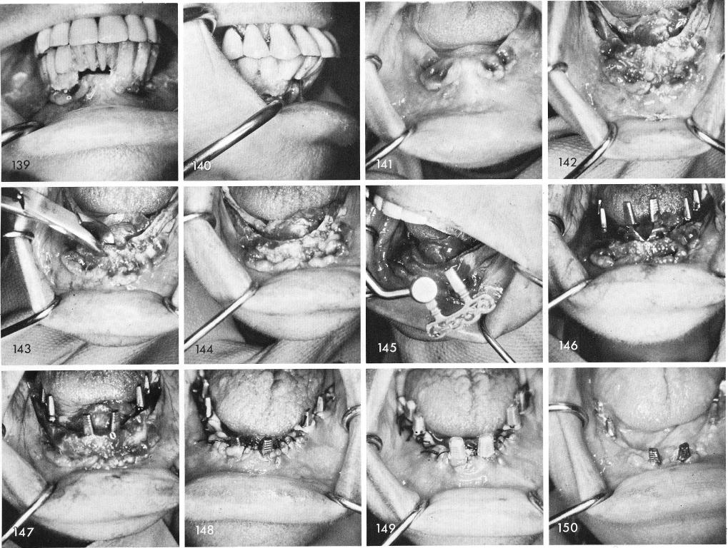 1 Mandibular removable conventional denture