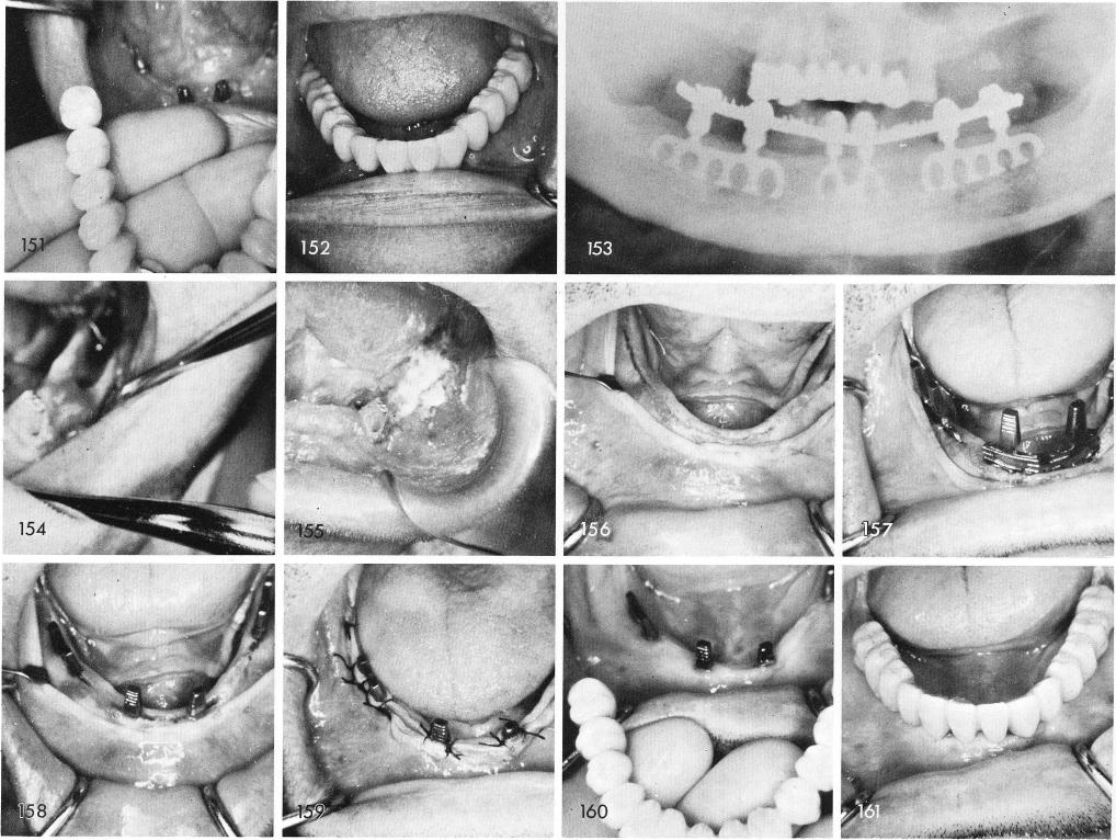 1 Failing mandibular blade implant that was over-retained in the bone