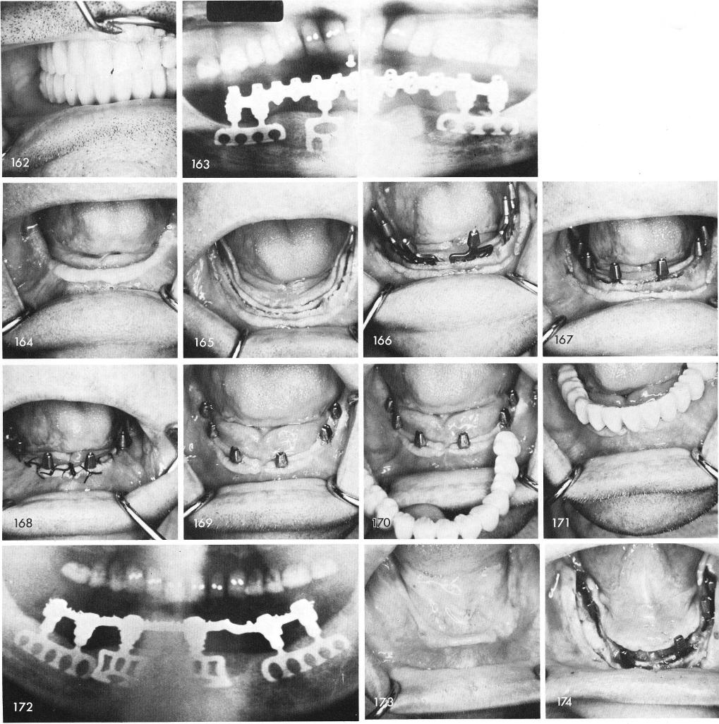 1 High and wide mandibular ridges