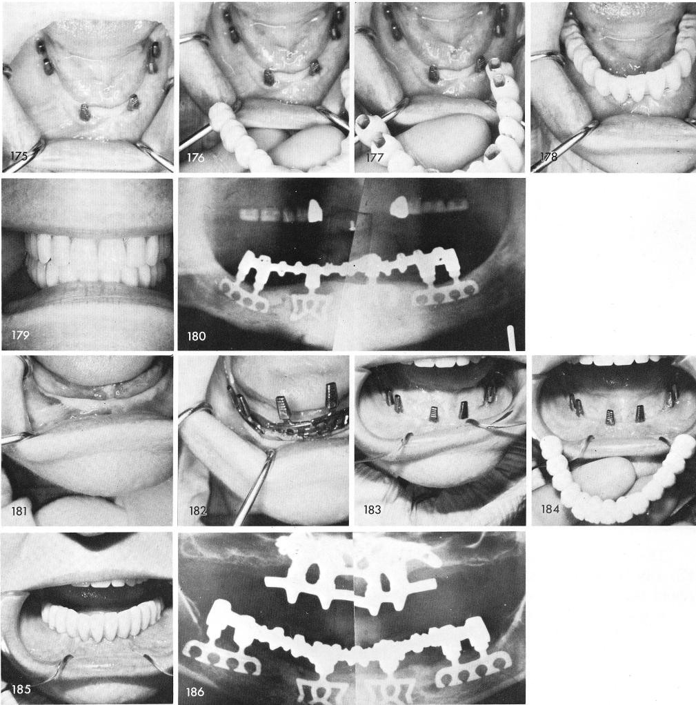 p 233 knife edge mandibular ridge with high muscle attachment for implants