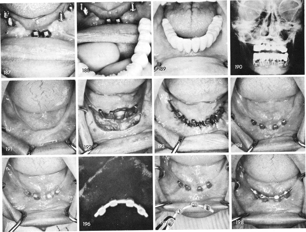 1 Postero-antero roentgenogram revealing curvature of mandibular blades