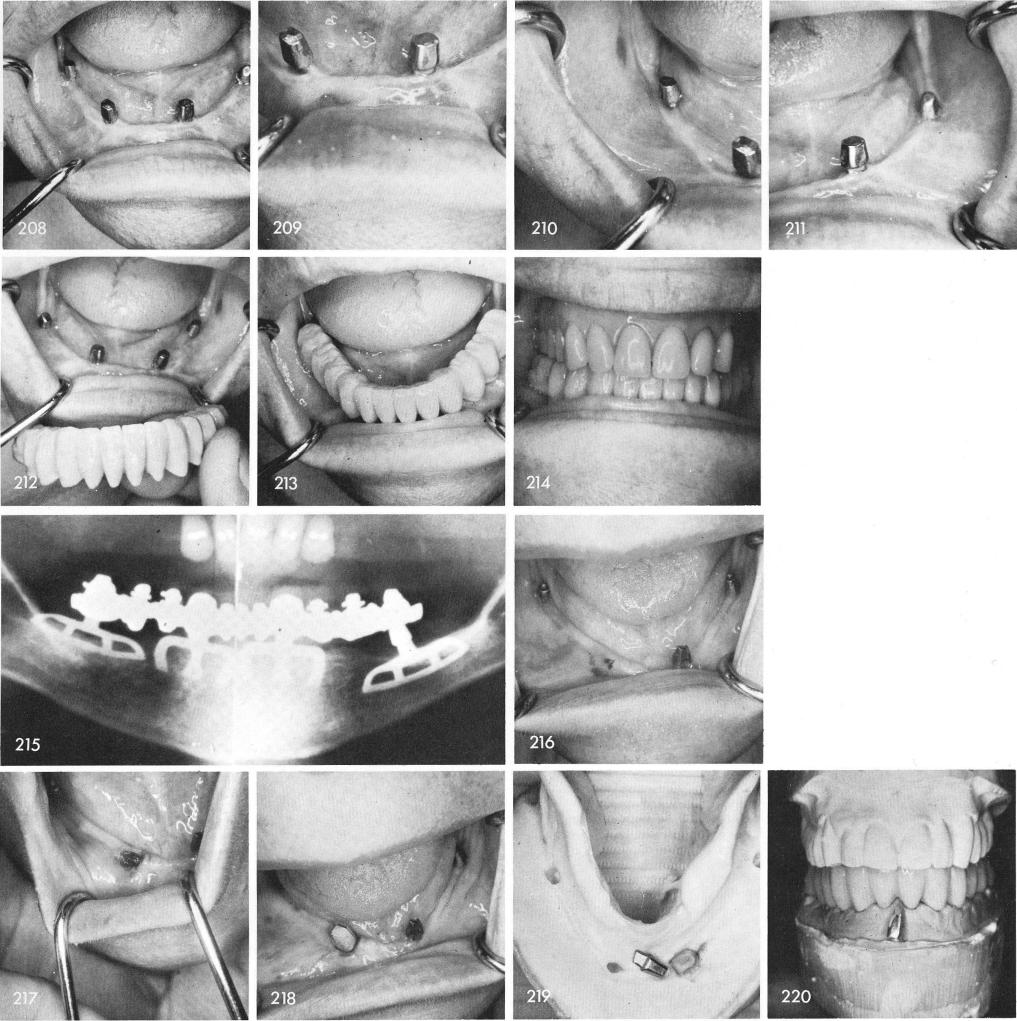 1 Mandibular blade implant posts after nine years of insertion