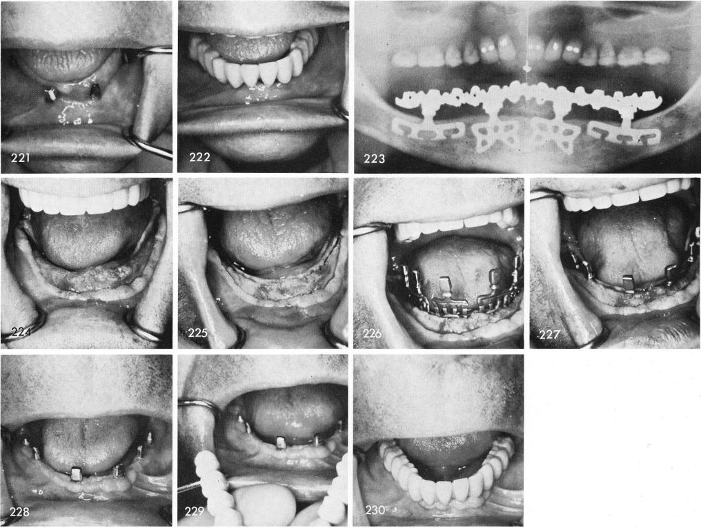 1 Fractured mandibular bladevent implant post replaced with golden post