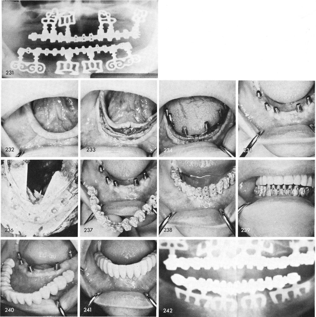 1 Labial roll over anatomical type in mandible