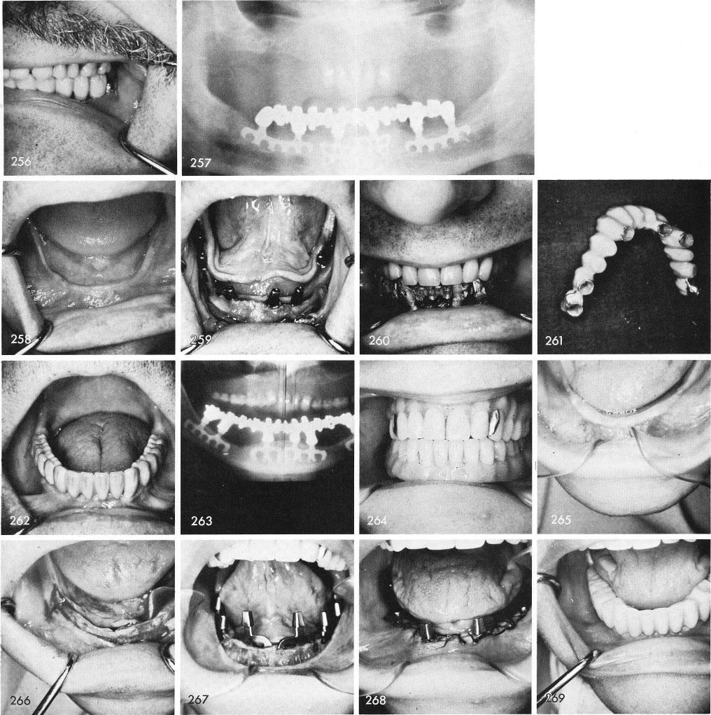 1 Prosthesis modifications for mandible with thick fibromucosal tissues