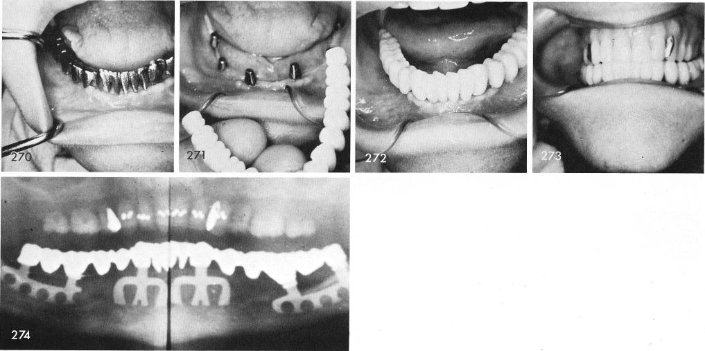 1 Fabrication of immediate mandibular temporary acrylic splint 