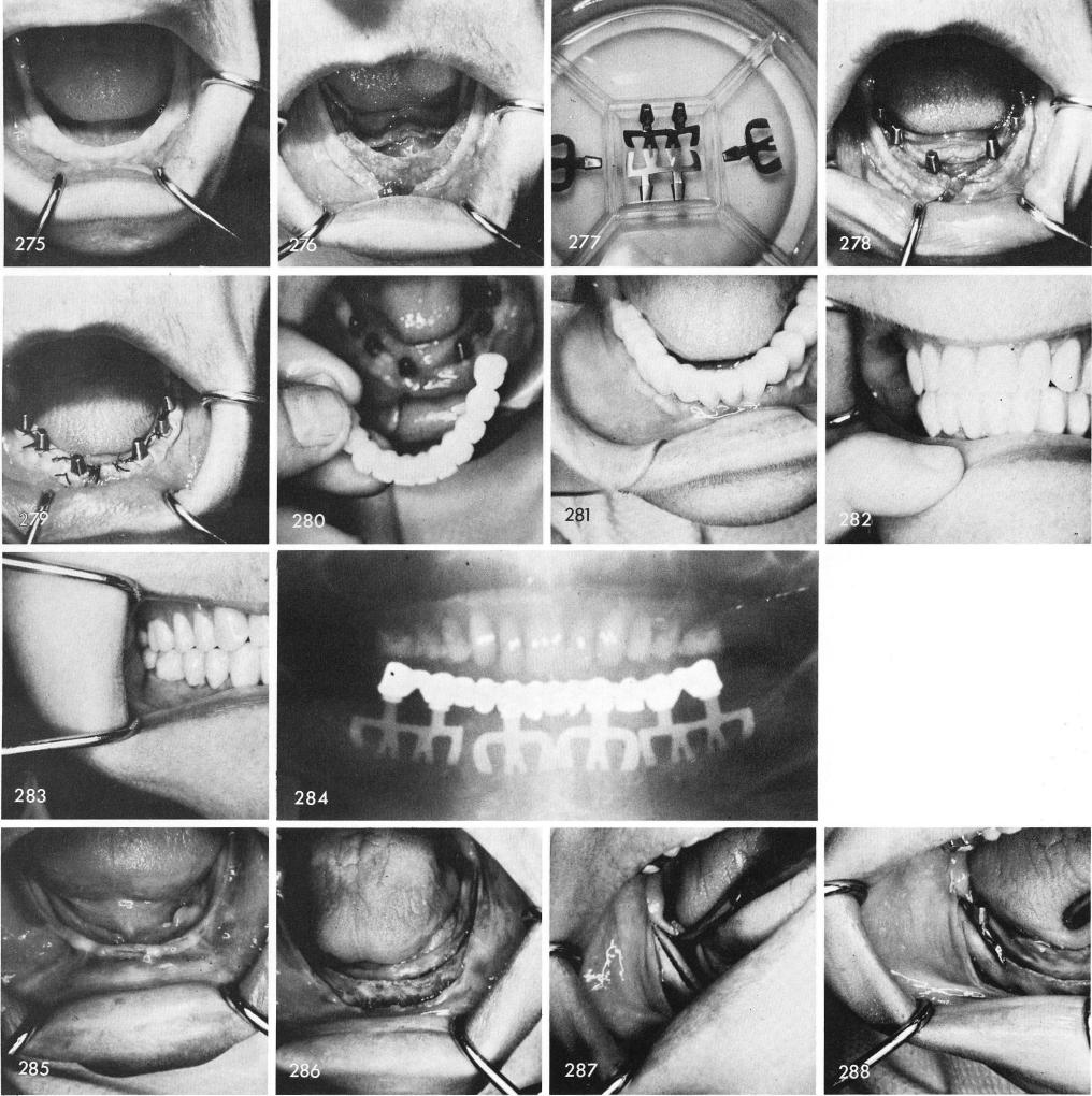 1  Tissues covering an extremely mandibular knife-edge ridge