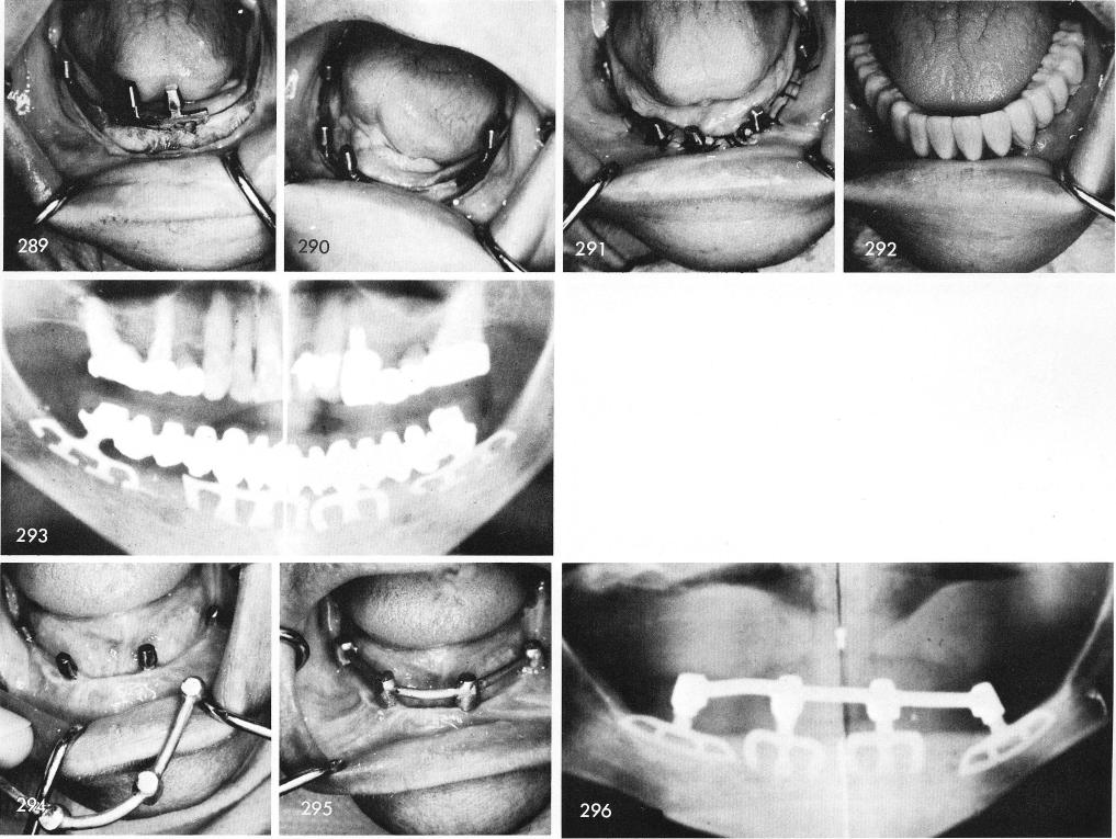 1 Widening mandibular ridge anteriorly for inserting blade implants