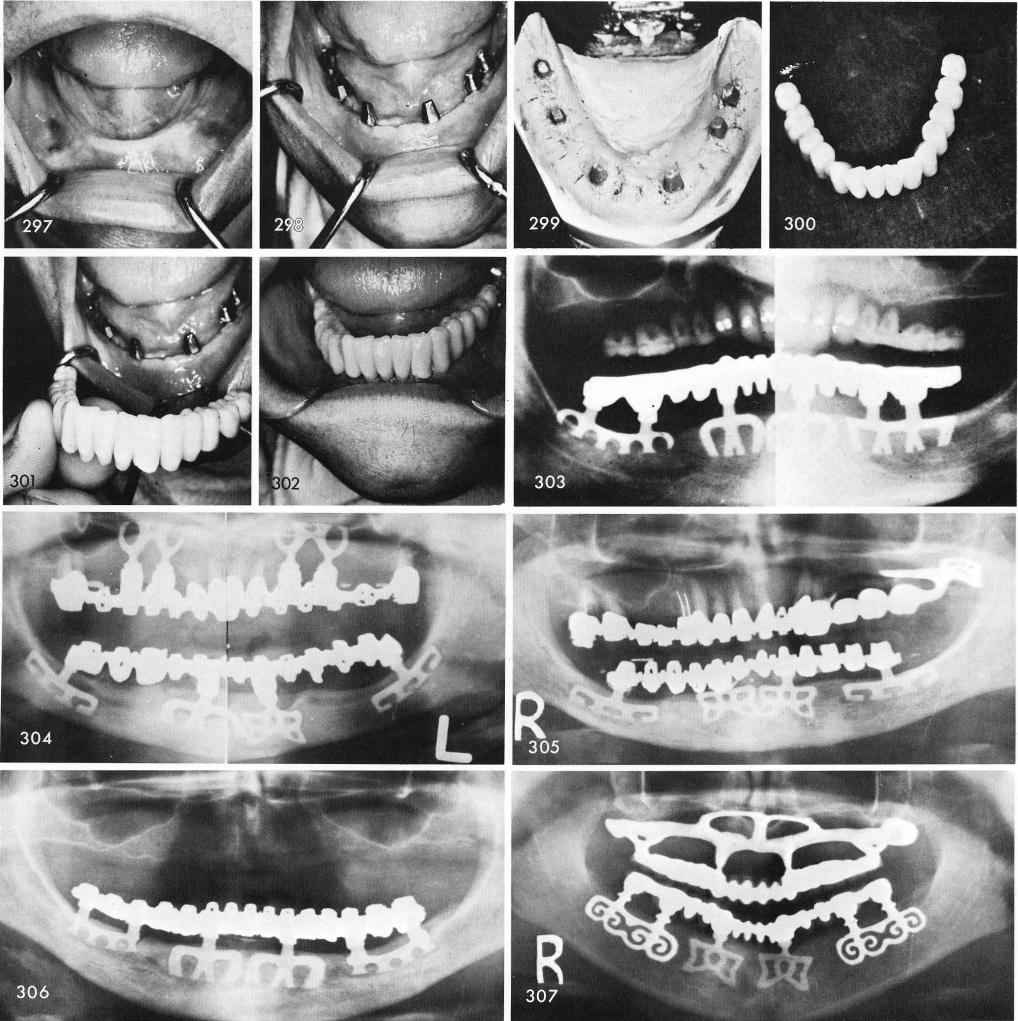1 Totally edentulous mandible with bladevent implants