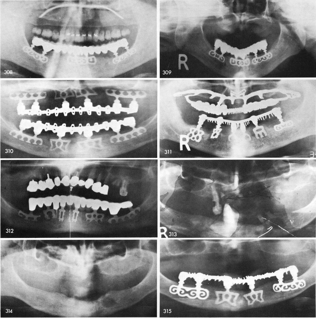 1 X-rays of totally edentulous mandibular blade implant cases