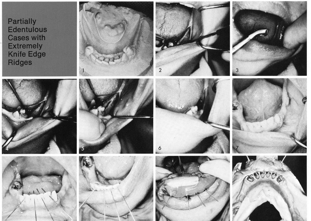 1 Widening mandibular occlusal table by reducing fragile crest bone