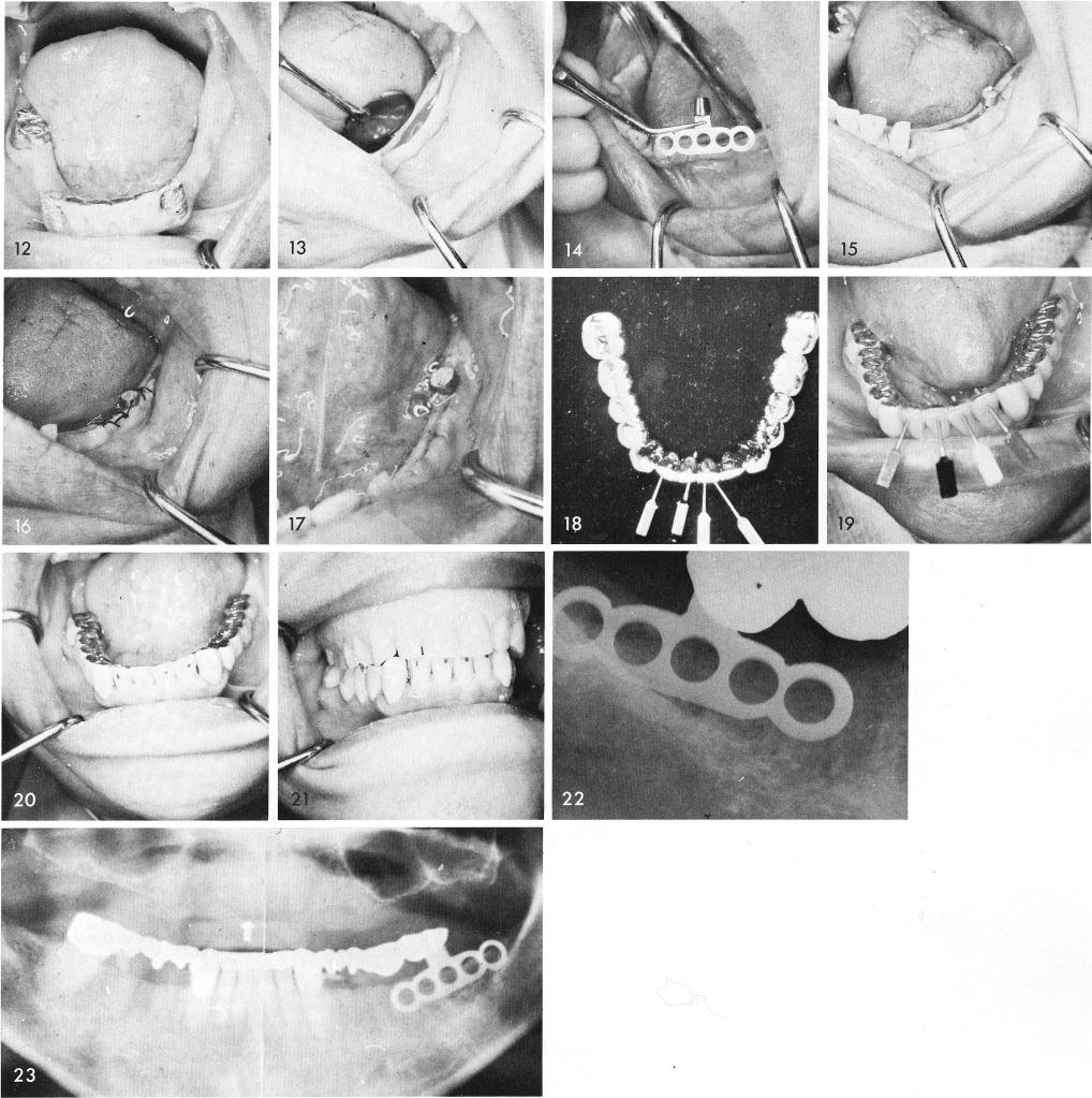 1 Acrylic veneer bridge cementation over mandibular implants using pins