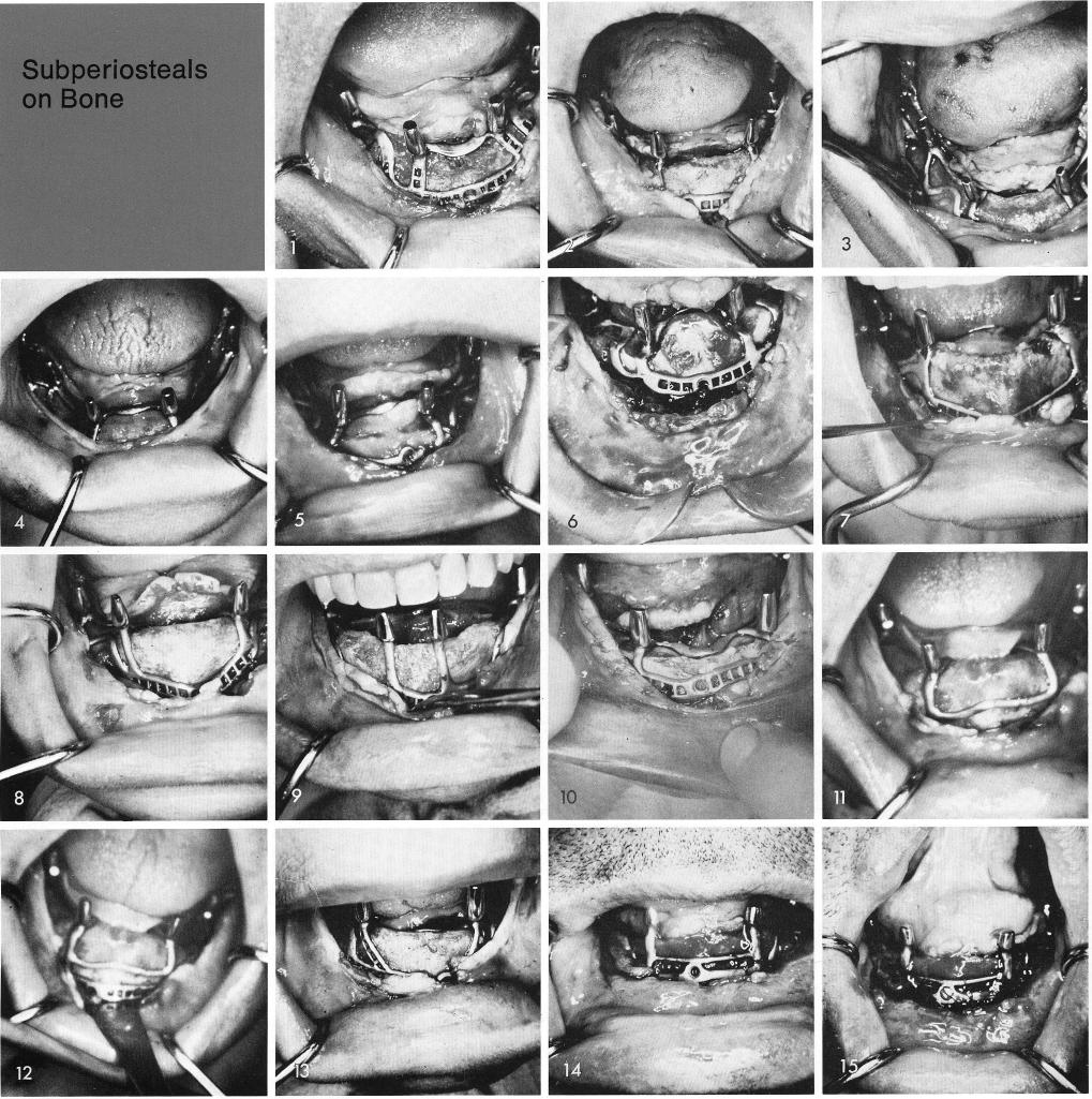1 Exact fit of many designed subperiosteal implants in mandible