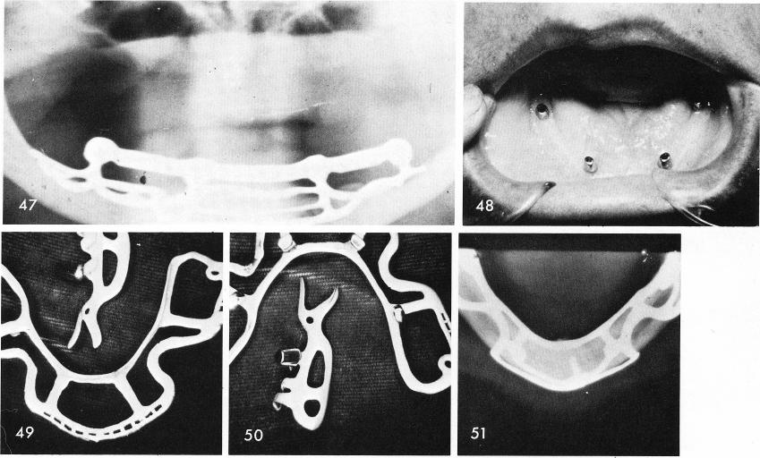 1 Seventeen year post-operative x-ray of a subperiosteal dental implant