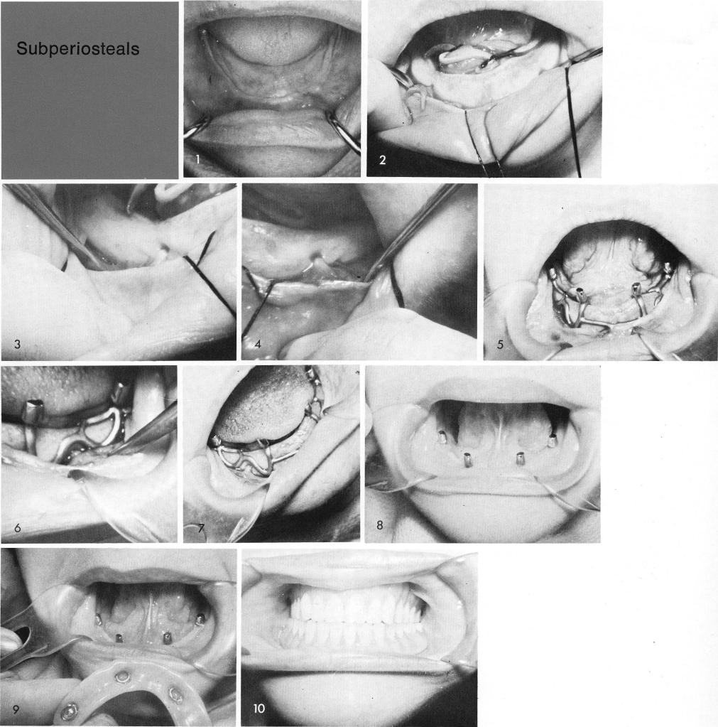 1 Flat mandibular ridge with little bone above inferior alveolar canal