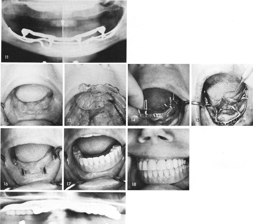 2 Labial and buccal incisions are made to the mandibular periosteum
