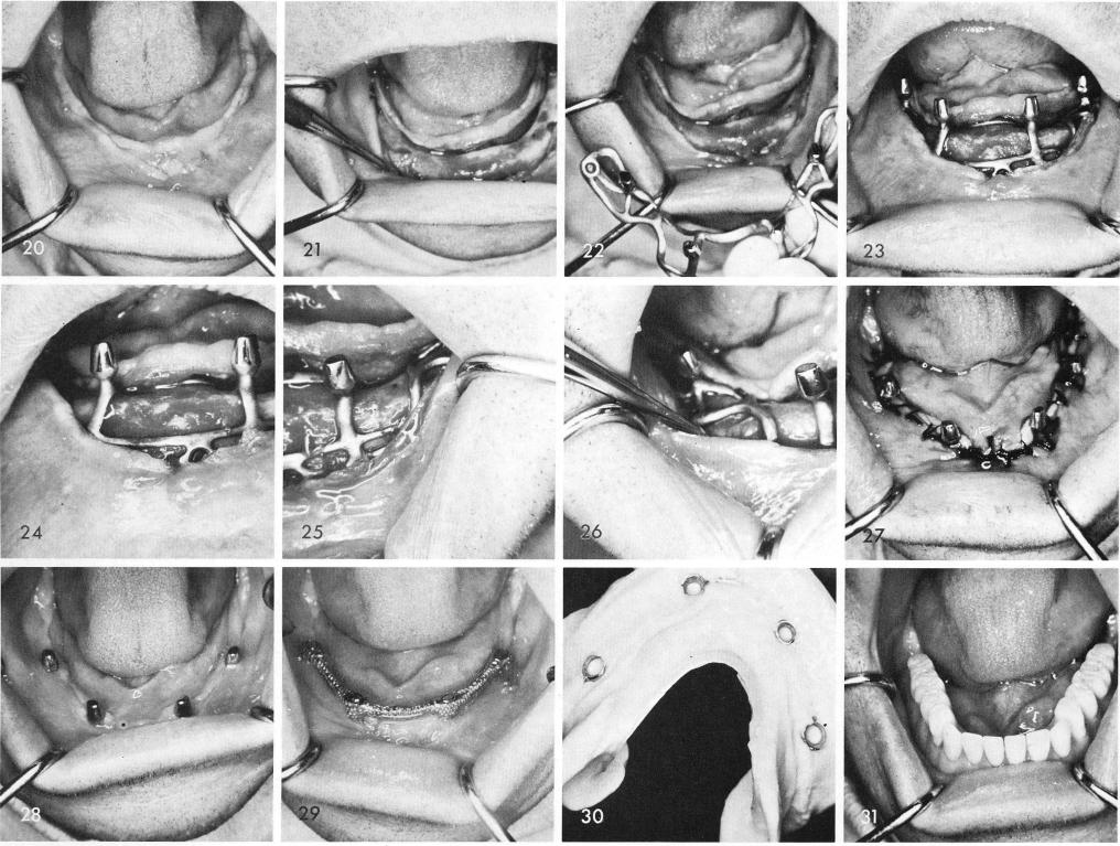 1 Placement of mandibular superstructure framework over implant posts