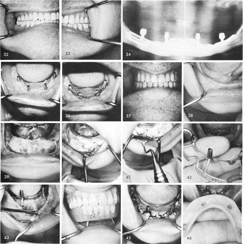 1 Mandibular asymmetry caused by asymmetrical muscle attachments