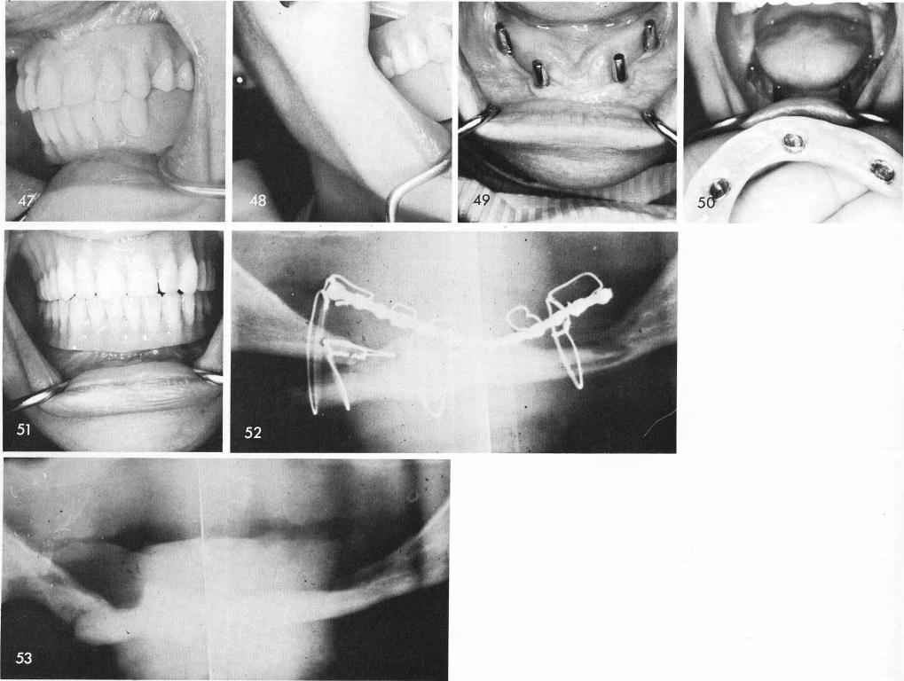 1 Necks of mandibular subperiosteal implant placed in attached gingivae