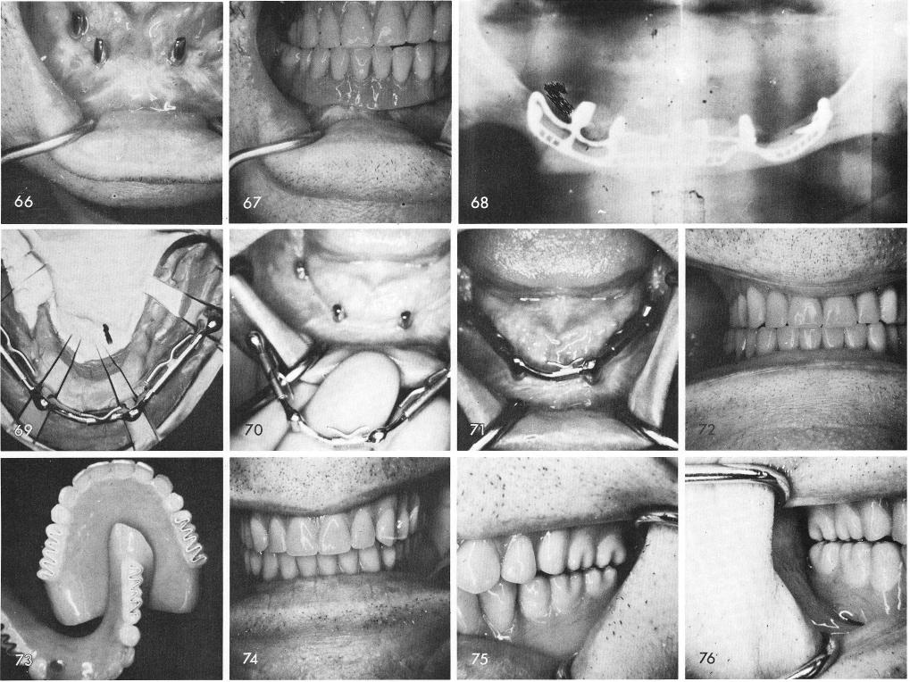 1 Dolder type bars attached to gold copings over mandibular implants