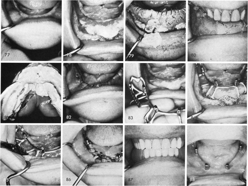 1 Heavy bodied impression botched by bur for a bite relationship