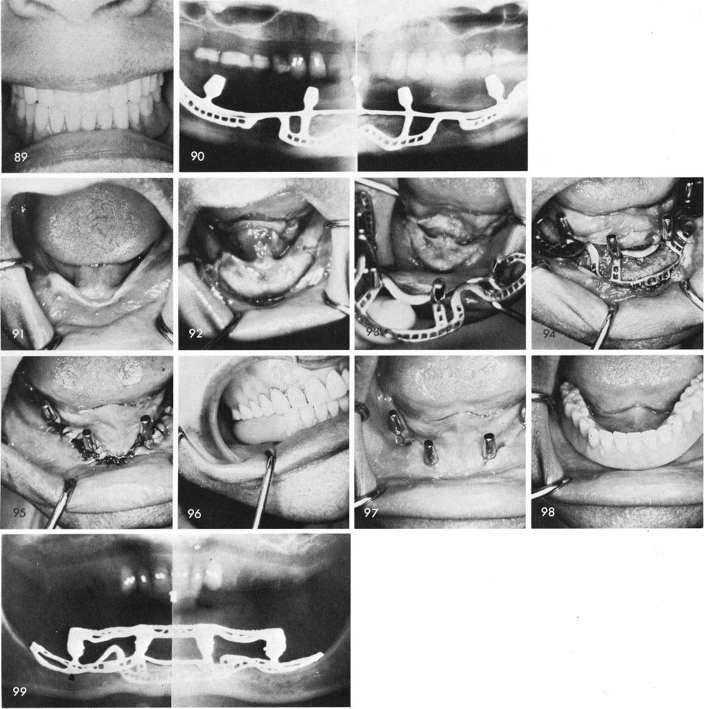 1 Completed mandibular implant denture without touching the tissues
