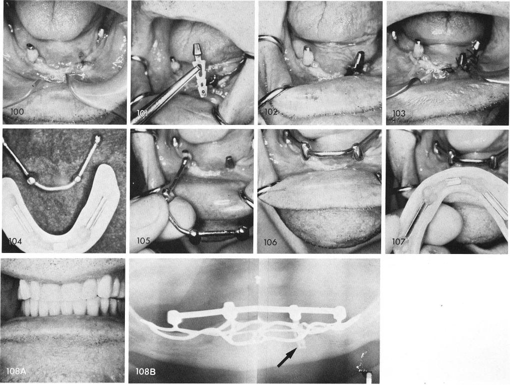 1 Mandibular bladevent insertion in area of previous implant fracture