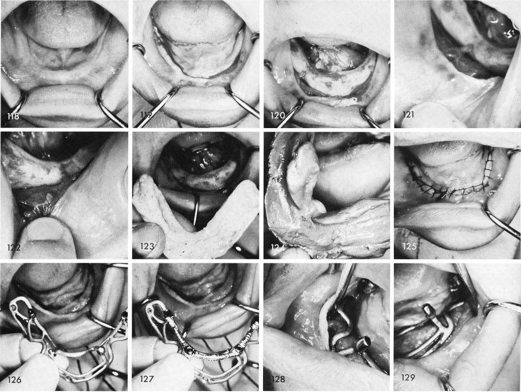 1 Lingual incision made if mental bundle is on crest of mandiblular ridge