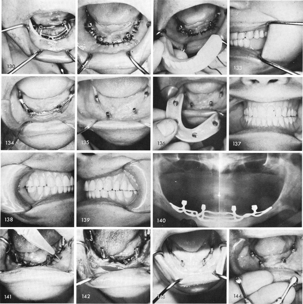 1 Accessory incisions placed lateral and buccal to mandibular implant