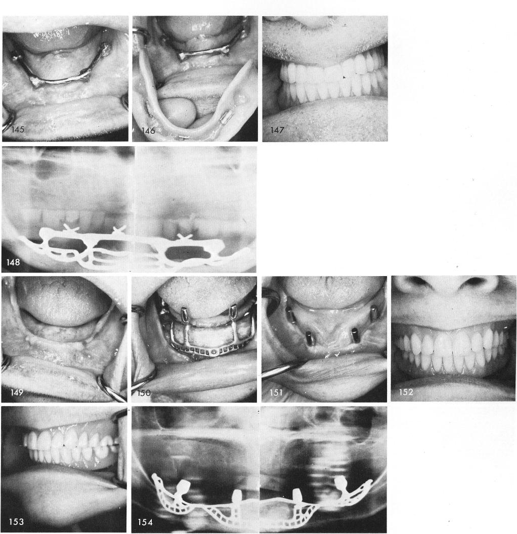1 Completed mandibular prosthesis over subperiosteal implant framework