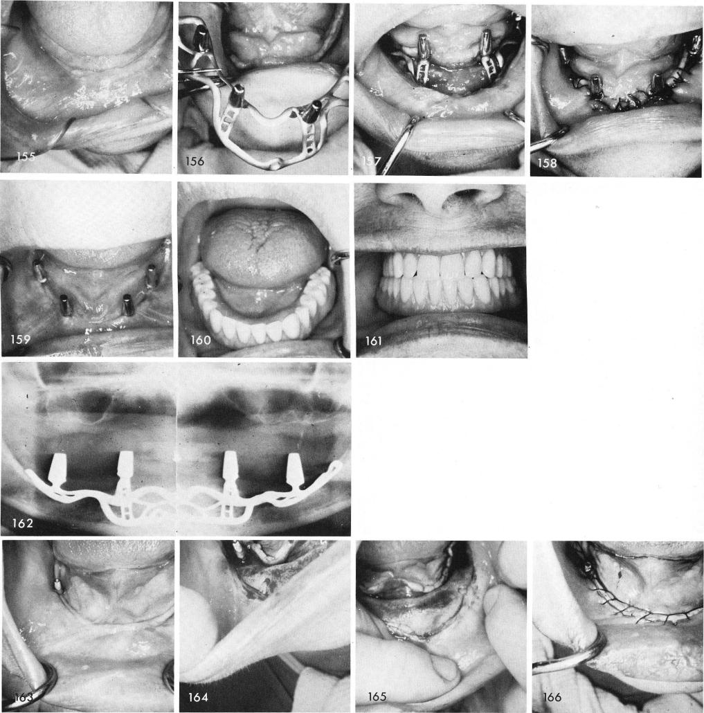 1 Exposure of mandibular bone revealing mental foramina