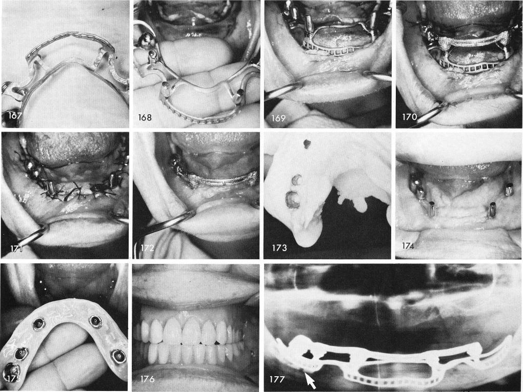 1 Casting framework with coping cemented over mandibular blade post