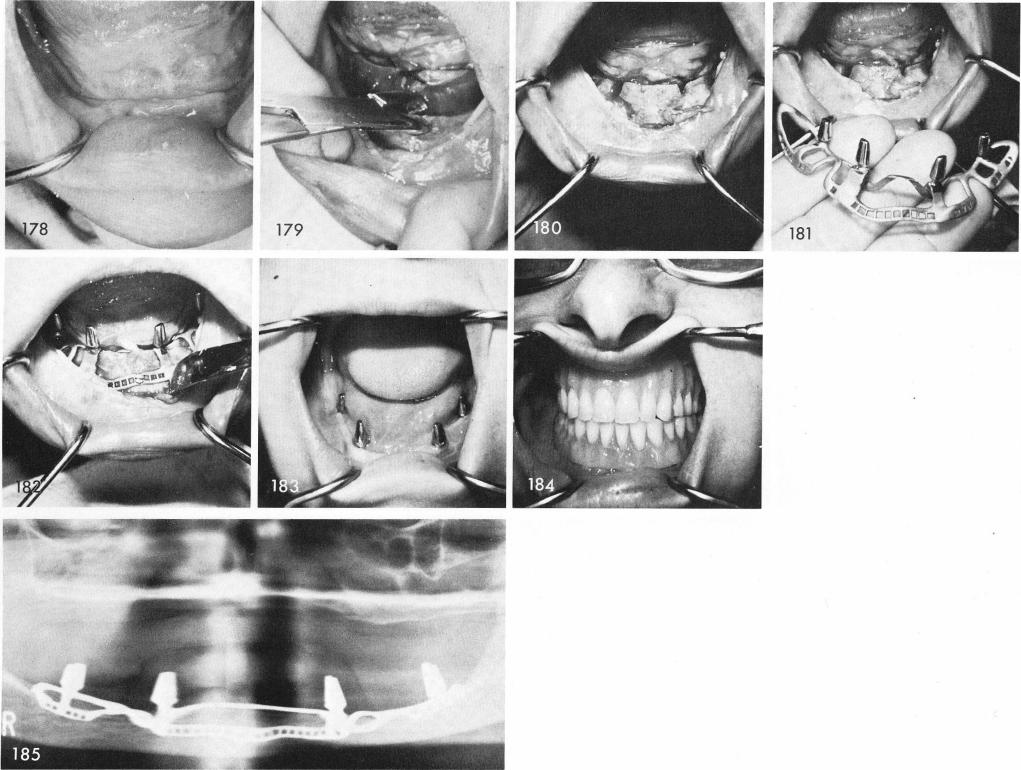 1 Clinical view of mandible with knife edge ridge