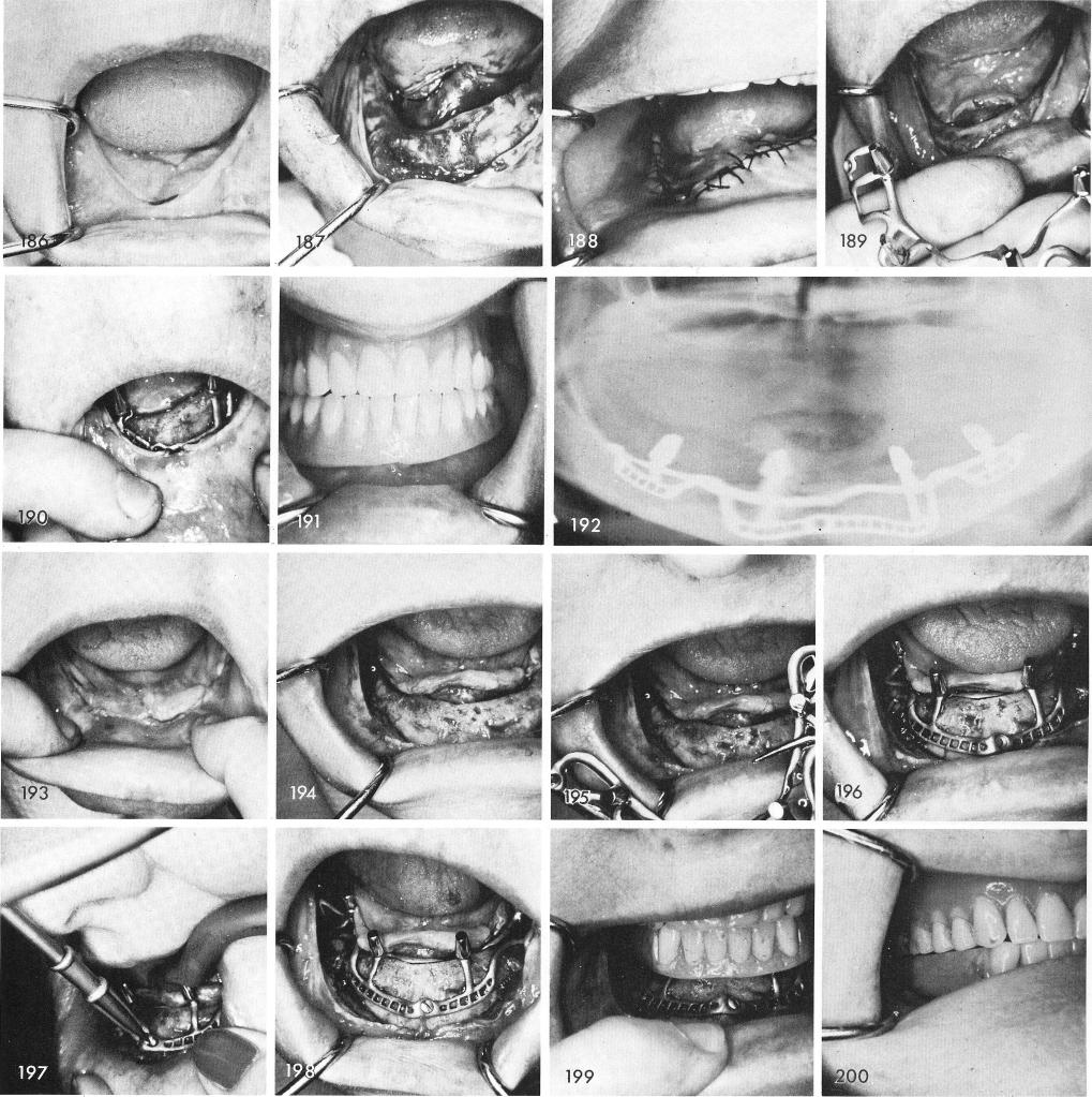 1 Asymmetrical mandible