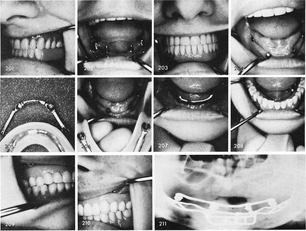 1 Short posts need Andrew`s type bar-coping system & clips in mandible