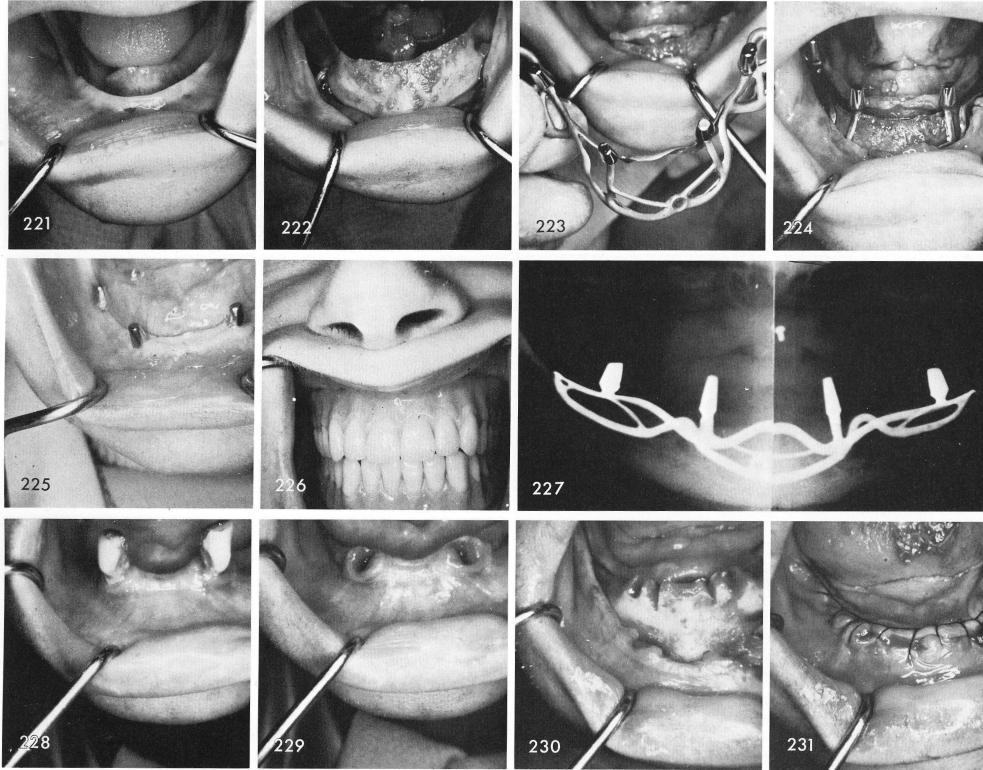 1 Existence of mandibular alveolar bone anteriorly